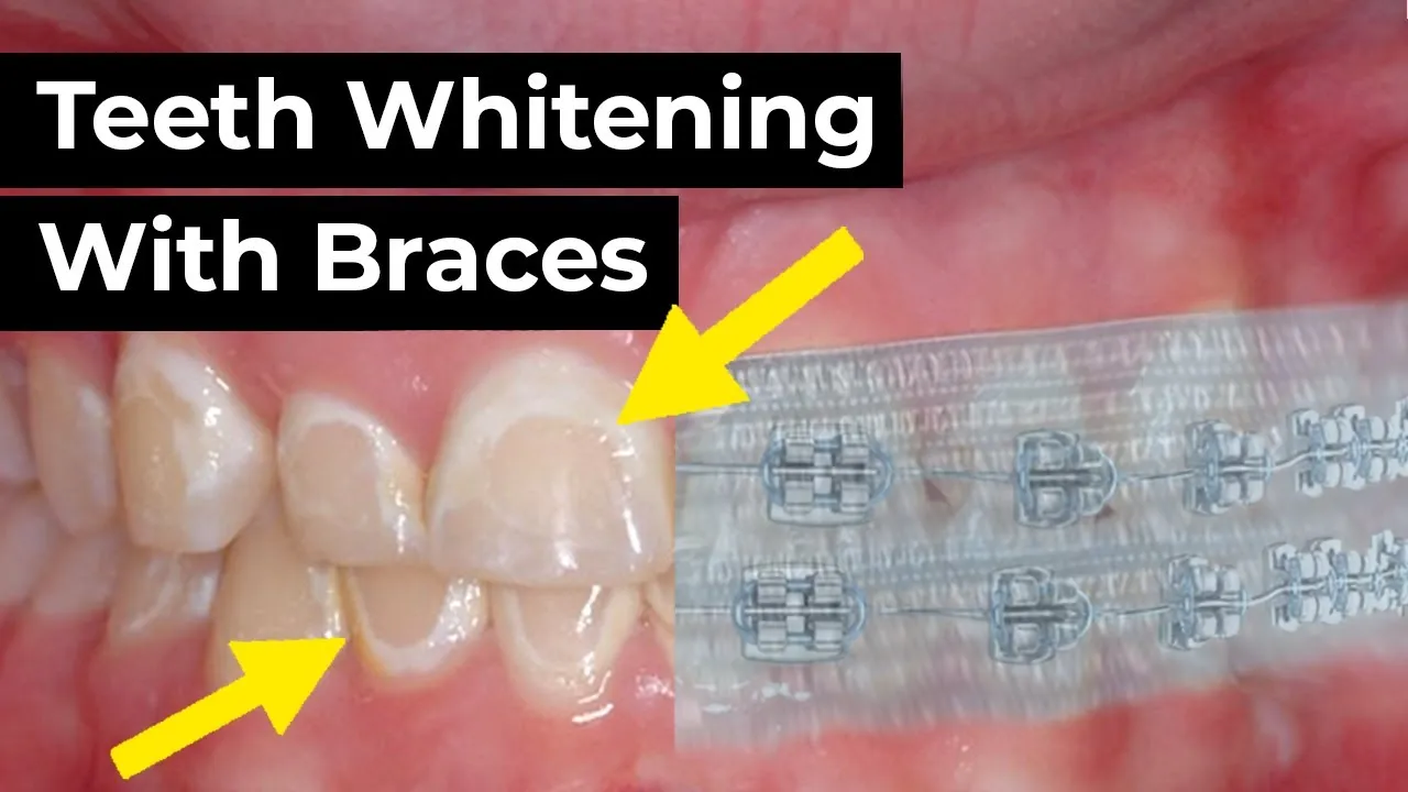 28995 teeth whitening process