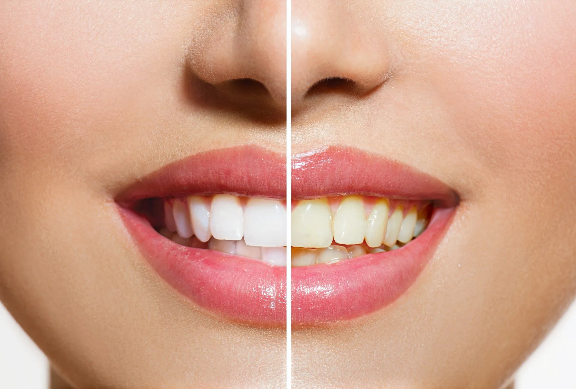 /img/28998-teeth-whitening-fading.webp