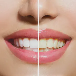 /img/28998-teeth-whitening-fading.webp