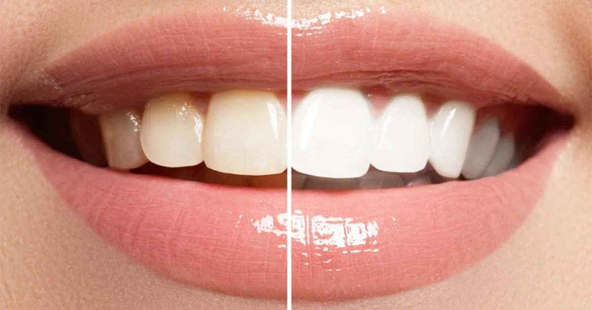 28998 types of teeth whitening