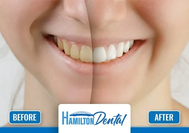 28999 in office whitening hamilton