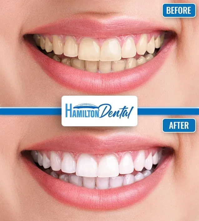 28999 teeth whitening hamilton