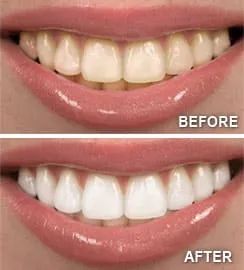 29002 teeth whitening ann arbor 1