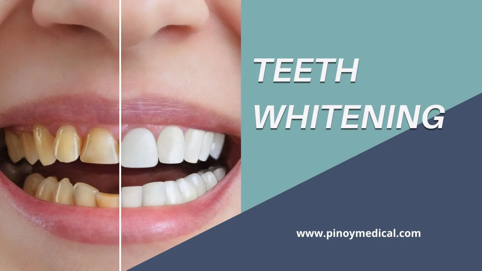 29003 compare tooth whitening prices
