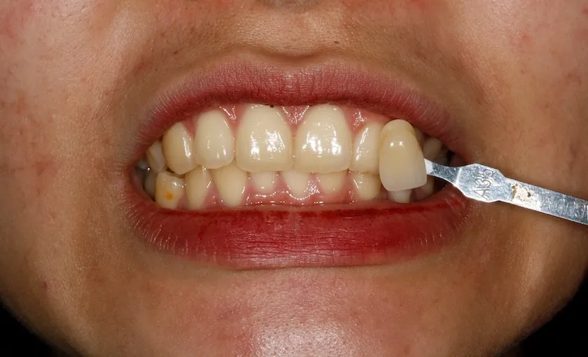 /img/29003-teeth-whitening-consultation.webp