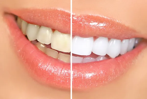 29006 professional teeth whitening
