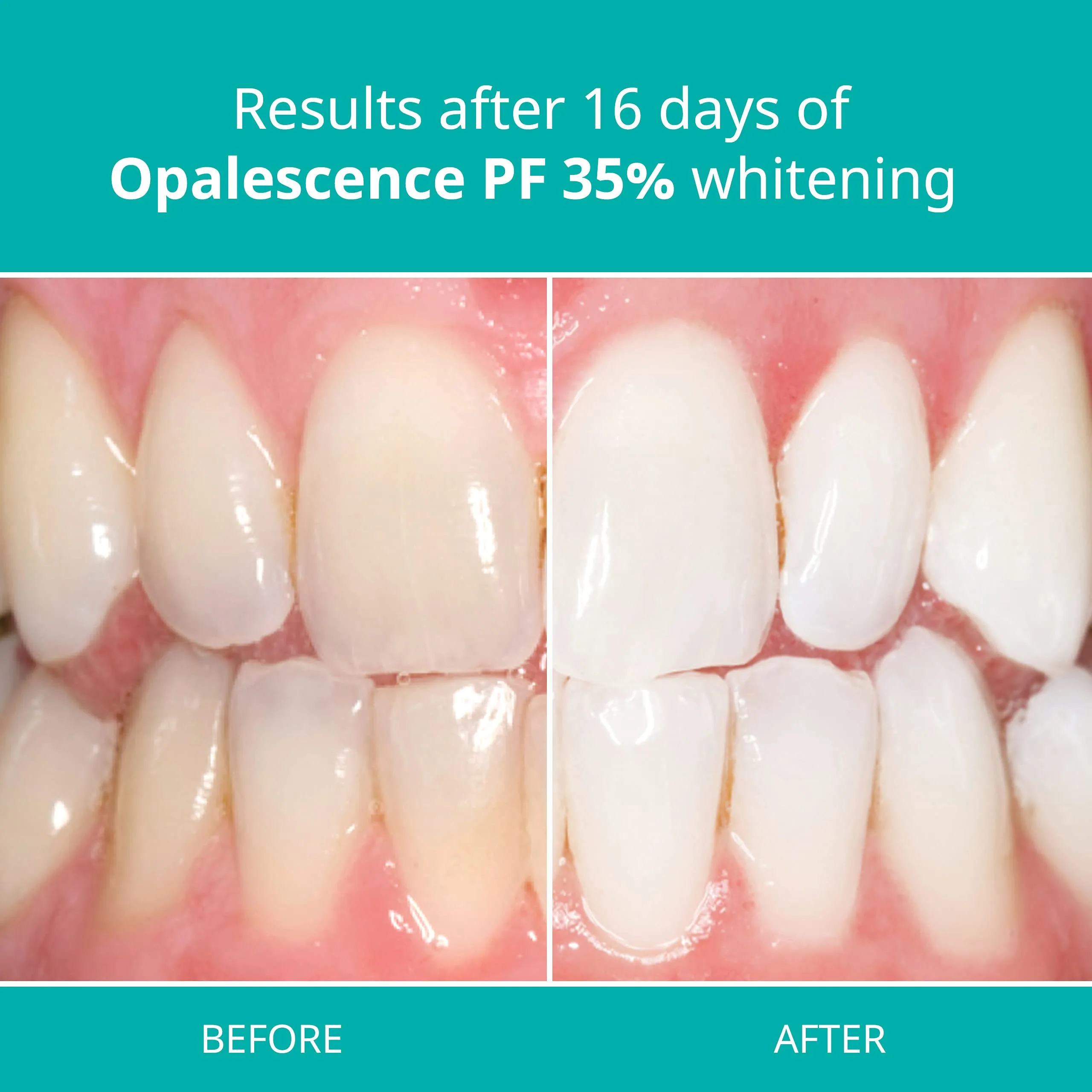 29009 teeth whitening gel application