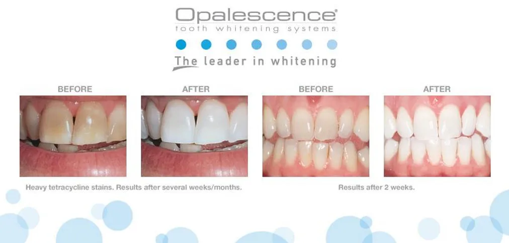 29009 teeth whitening sensitivity
