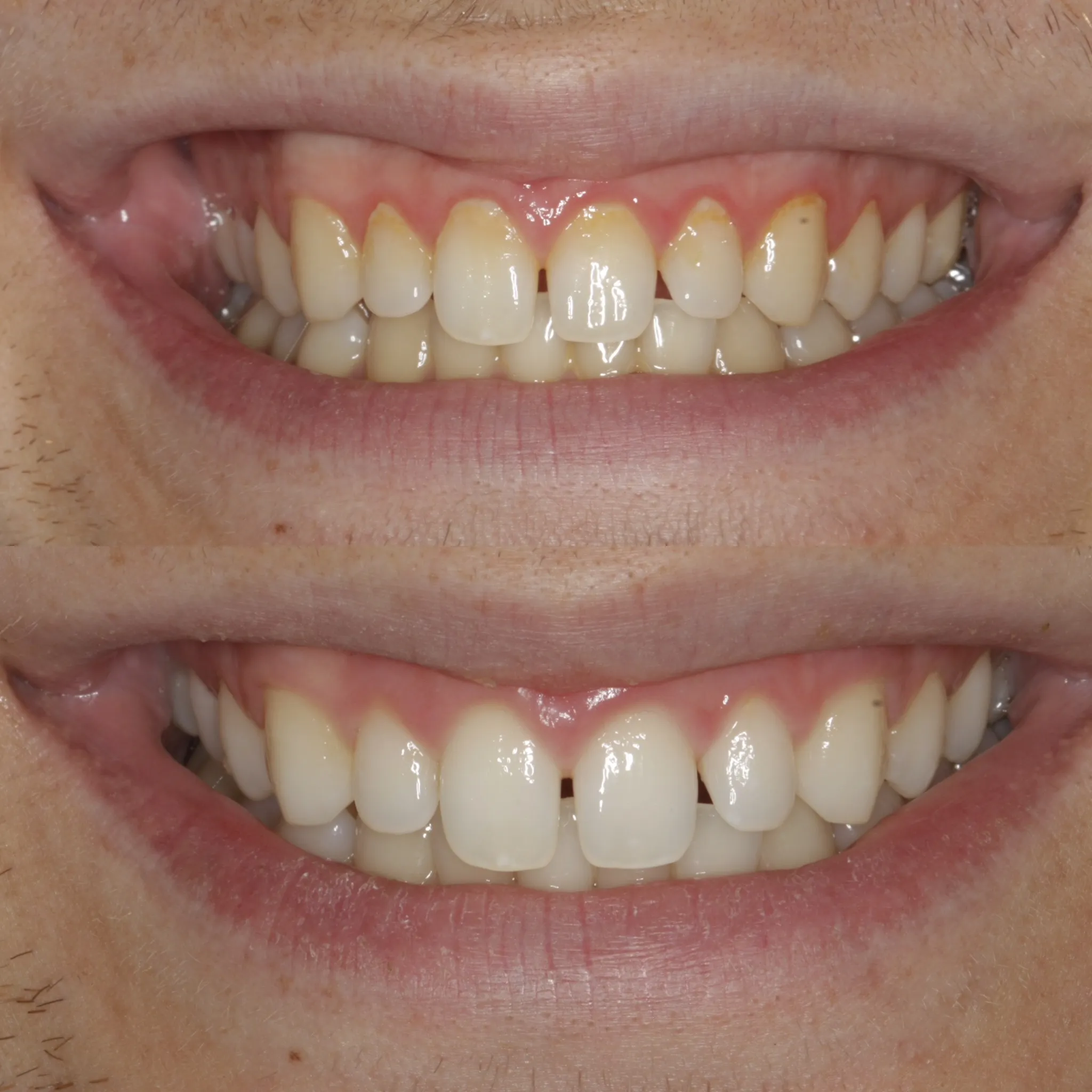 29010 in office teeth whitening procedure