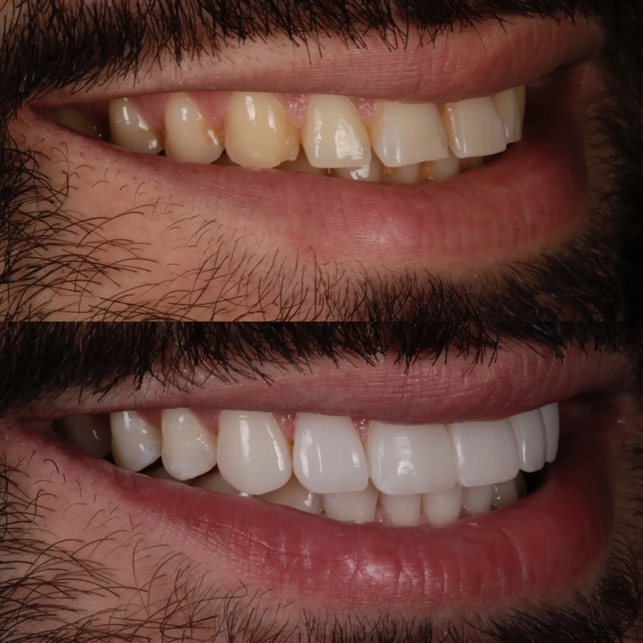 29010 professional teeth whitening edinburgh