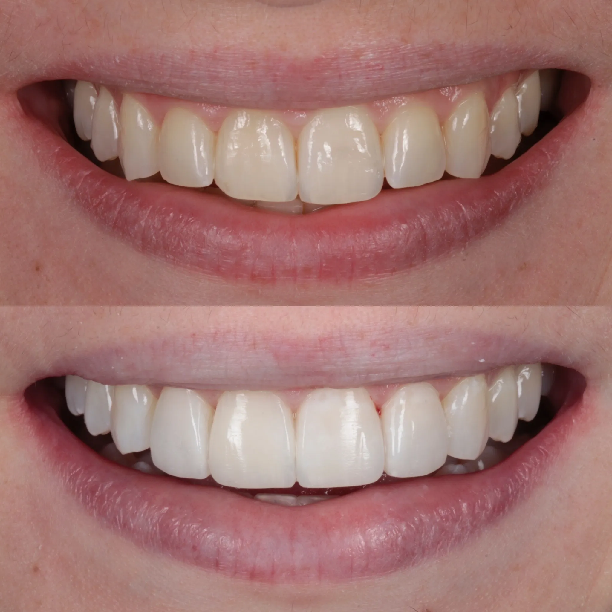 29010 take home teeth whitening kits