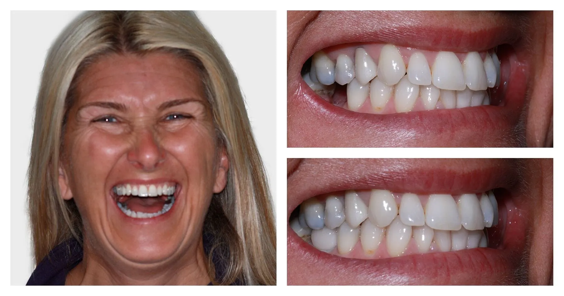 29010 teeth whitening aftercare