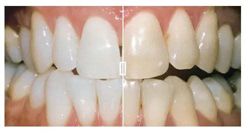 29010 teeth whitening cost edinburgh
