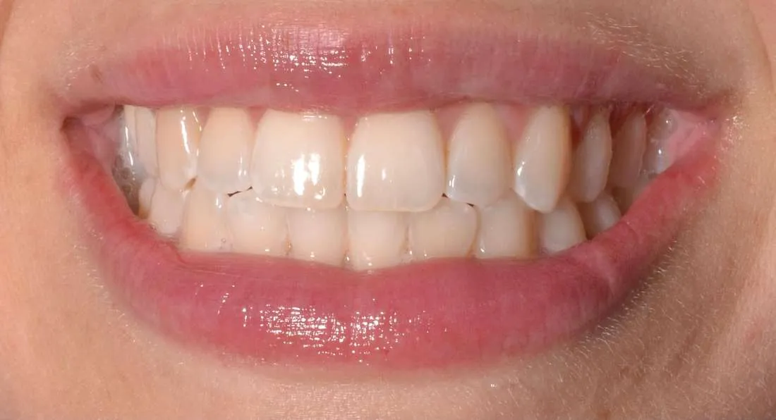 29015 teeth whitening allentown pa 1