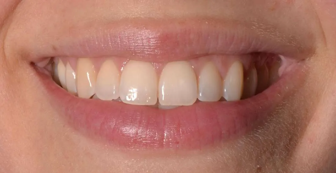 29015 teeth whitening allentown pa 2