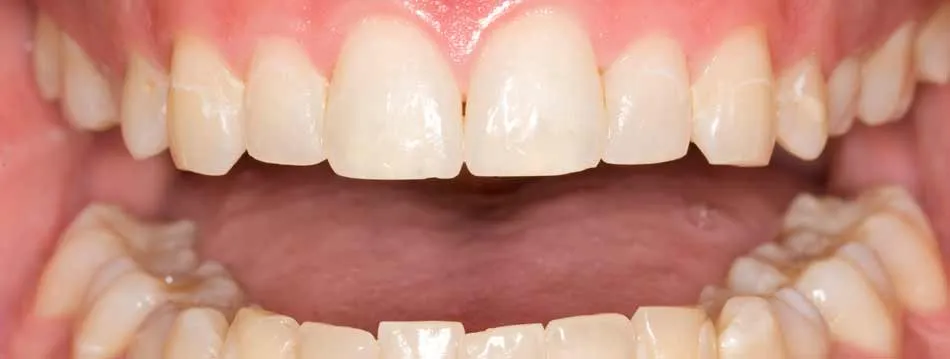 29015 teeth whitening allentown pa 3