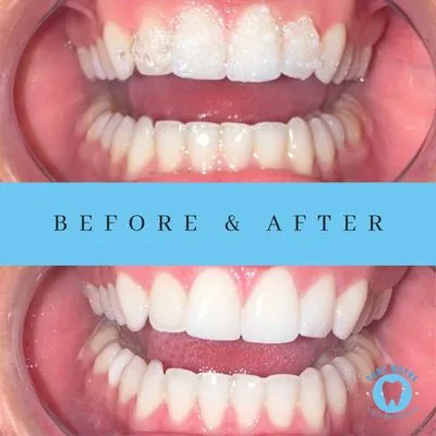 29016 teeth whitening fort wayne 1