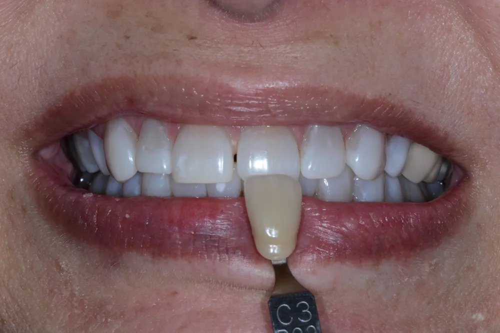 29016 teeth whitening fort wayne 5