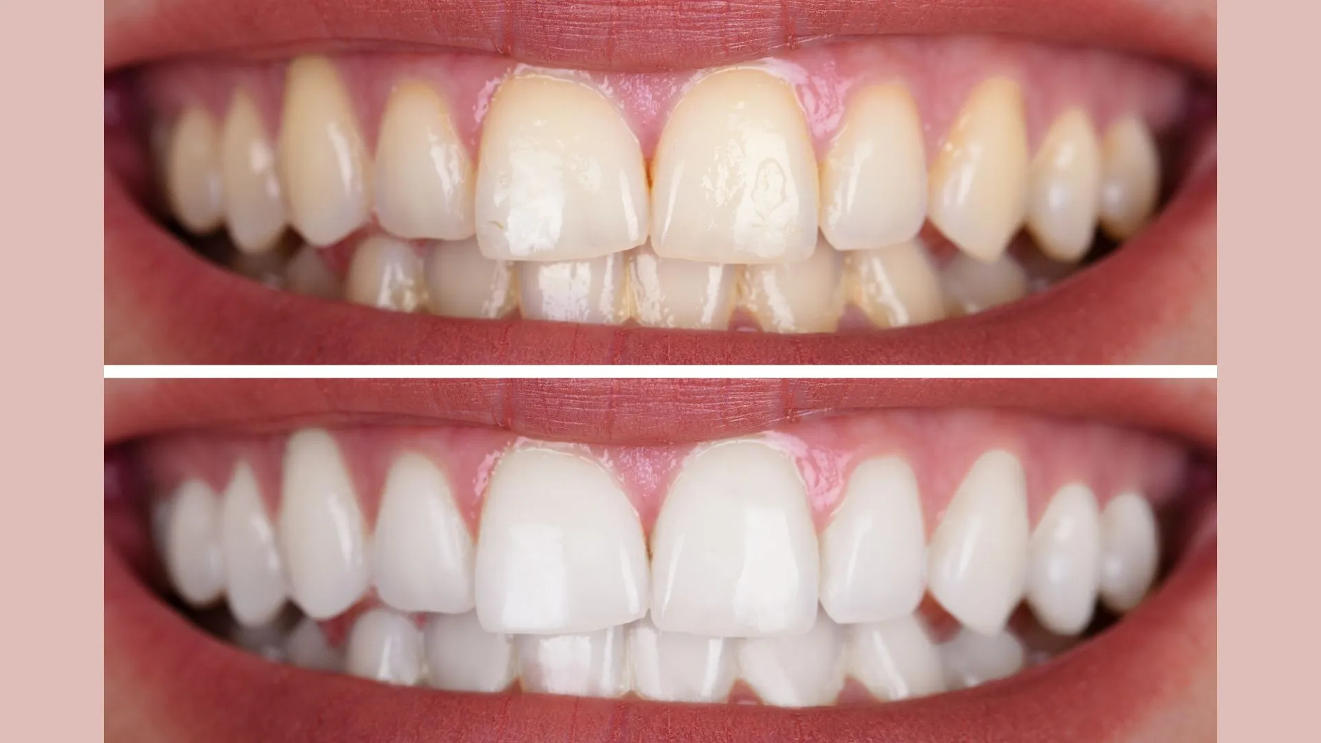 29027 types of teeth whitening