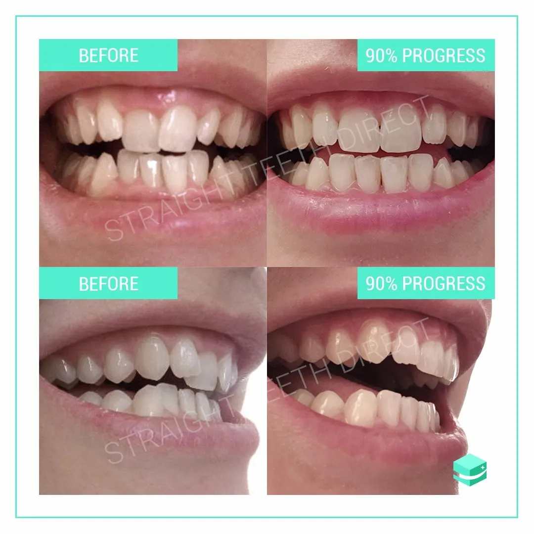 29030 smile direct whitening sensitivity